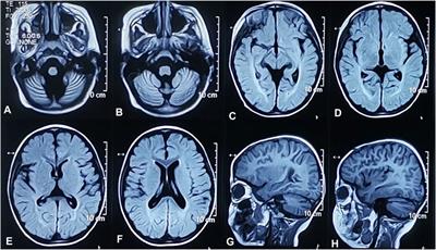 Case Report: Novel MFSD8 Variants in a Chinese Family With Neuronal Ceroid Lipofuscinoses 7